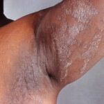 11-Bacterial-Skin-Infections-and-How-Theyre-Treated.jpg
